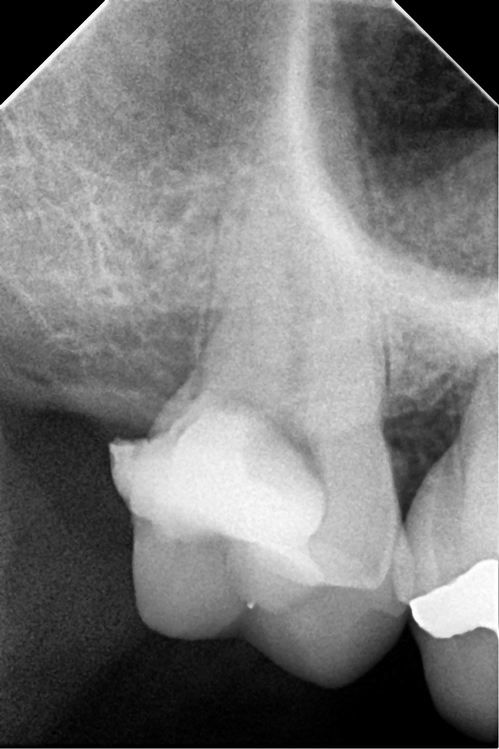 Radiografía inicial - molar con 5 conductos